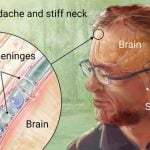 meningitis outbreak in Durban