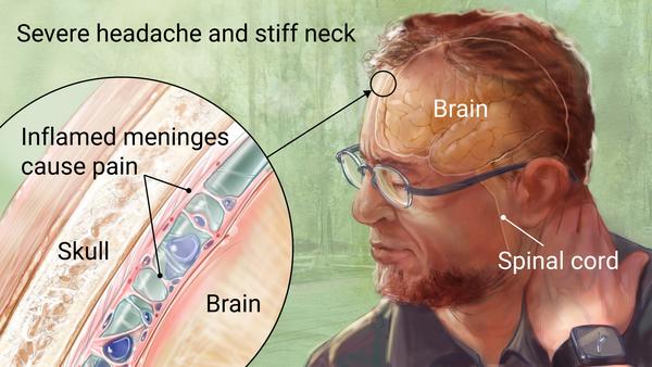 meningitis outbreak in Durban